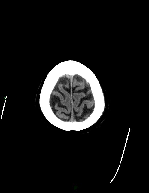 Bilateral acute middle cerebral artery territory infarcts (Radiopaedia 77319-89401 Axial non-contrast 84).jpg