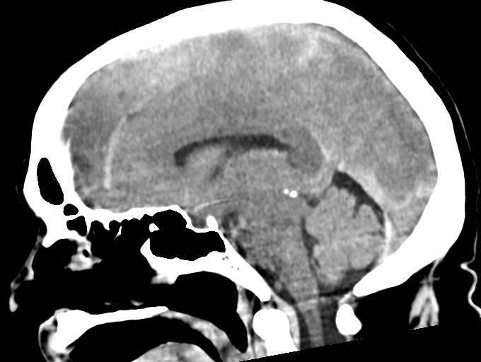 Bilateral acute on chronic subdural hematomas (Radiopaedia 78466-91146 C 30).jpg