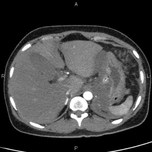 Bilateral adrenal gland hyperenhancement in pancreatitis (Radiopaedia 86642-102753 B 24).jpg