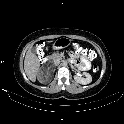 Bilateral adrenal myelolipoma (Radiopaedia 63058-71535 Axial C+ delayed 41).jpg