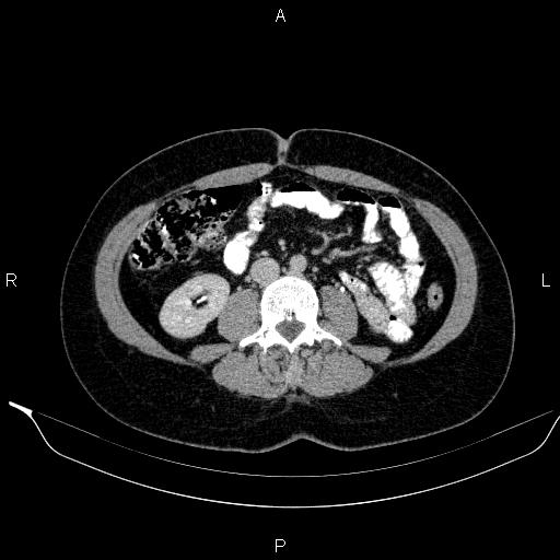 Bilateral adrenal myelolipoma (Radiopaedia 63058-71535 Axial C+ delayed 76).jpg