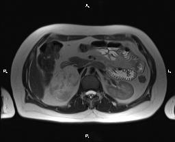 File:Bilateral adrenal myelolipoma (Radiopaedia 63058-71537 Axial T2 17).jpg