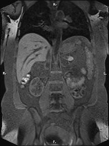 Bilateral adrenal myelolipoma (Radiopaedia 63058-71537 Coronal T1 fat sat 46).jpg