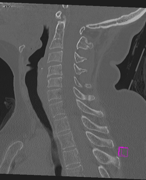 Bilateral atlanto-occipital assimilation (Radiopaedia 28350-28603 Sagittal bone window 42).jpg