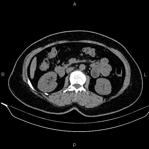 Bilateral benign adrenal adenomas (Radiopaedia 86912-103124 Axial non-contrast 53).jpg