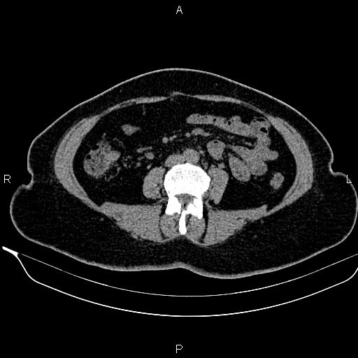 Bilateral benign adrenal adenomas (Radiopaedia 86912-103124 Axial non-contrast 66).jpg