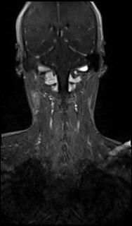 Bilateral carotid body tumors and right glomus jugulare tumor (Radiopaedia 20024-20060 MRA 54).jpg