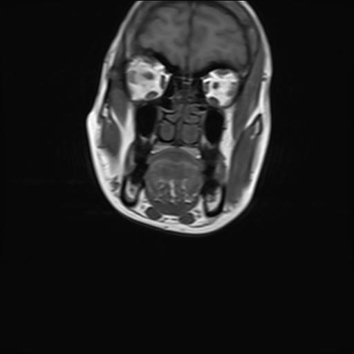 File:Bilateral carotid body tumors and right jugular paraganglioma (Radiopaedia 20024-20060 Coronal 13).jpg