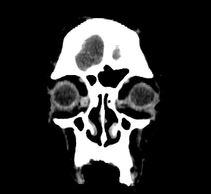 Bilateral ectopia lentis (Radiopaedia 89889-107013 Coronal non-contrast 17).jpg