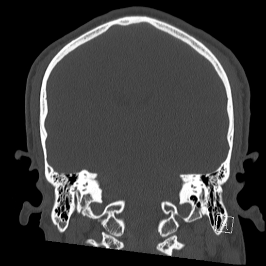 Bilateral occipital condyle fracture (type 2) (Radiopaedia 87675-104089 Coronal bone window 82).jpg