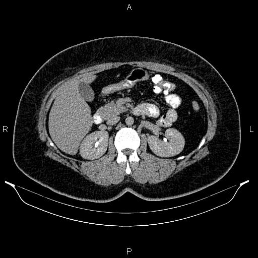 Bilateral ovarian dermoid cysts (Radiopaedia 85785-101603 Axial C+ delayed 25).jpg