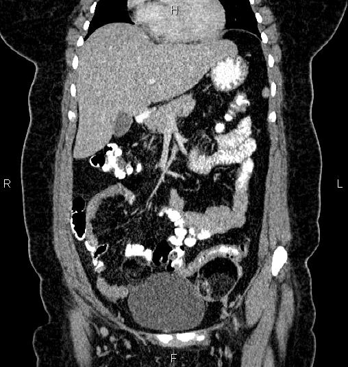 Bilateral ovarian dermoid cysts (Radiopaedia 85785-101603 C 15).jpg