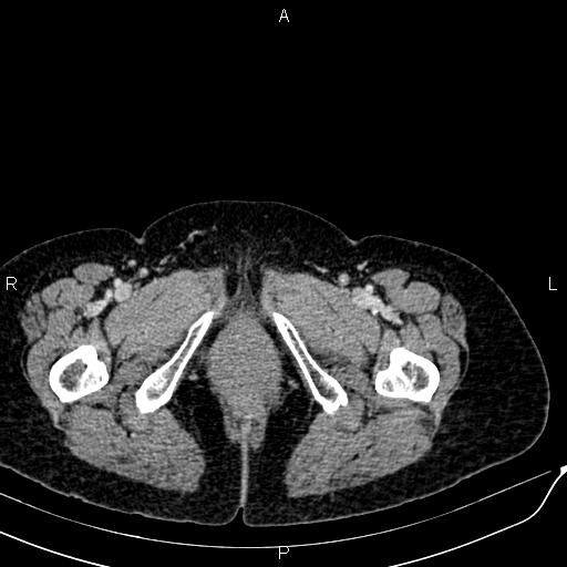 Bilateral ovarian serous cystadenocarcinoma (Radiopaedia 86062-101989 B 109).jpg