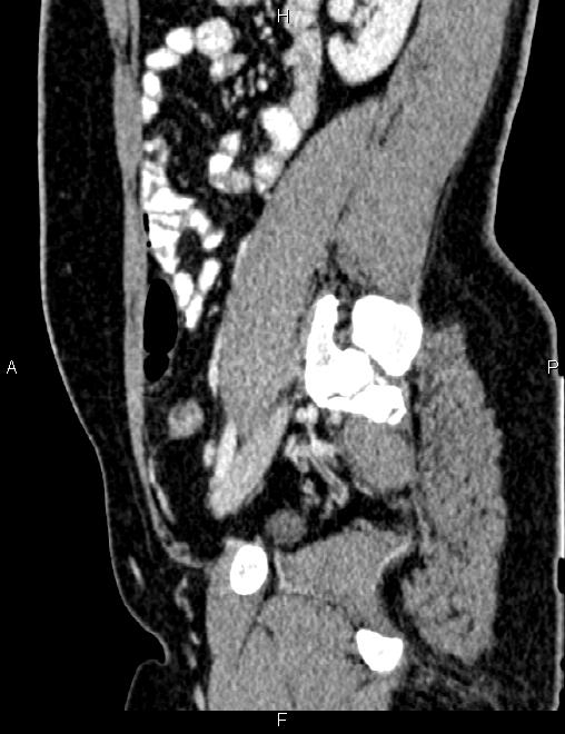 Bilateral ovarian teratoma (Radiopaedia 83131-97503 D 77).jpg
