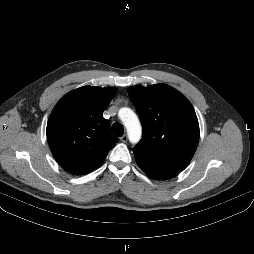 Bilateral pulmonary AVM (Radiopaedia 83134-97505 A 21).jpg