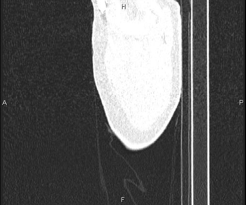 Bilateral pulmonary AVM (Radiopaedia 83134-97505 Sagittal lung window 7).jpg
