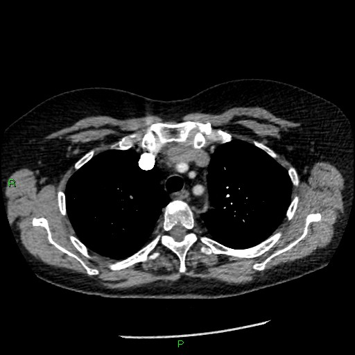 Bilateral pulmonary emboli (Radiopaedia 32700-33669 Axial C+ CTPA 26).jpg