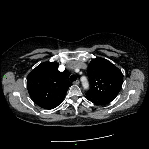 Bilateral pulmonary emboli (Radiopaedia 32700-33669 Axial C+ CTPA 28).jpg