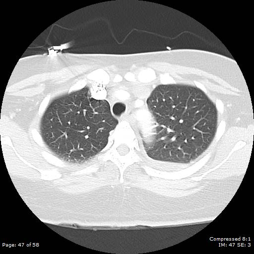 Bilateral pulmonary emboli with Hampton hump sign (Radiopaedia 54070-60246 Axial lung window 47).jpg