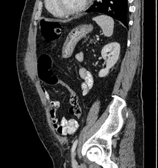 Bilateral rectus sheath hematomas (Radiopaedia 50778-56252 B 57).jpg