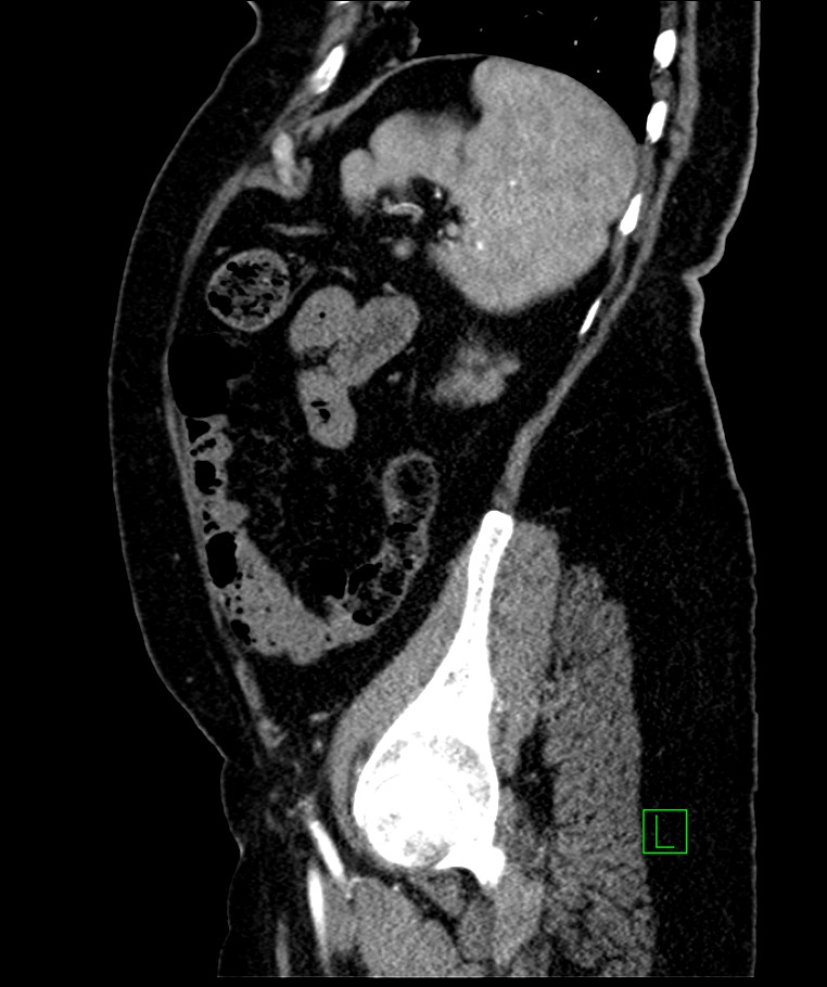Bilateral sporadic synchronous clear cell renal cell carcinoma (Radiopaedia 85035-100575 E 34).jpg