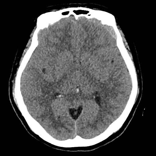 Bilateral subacute subdural hematoma (Radiopaedia 69240-79018 Axial non-contrast 23).jpg