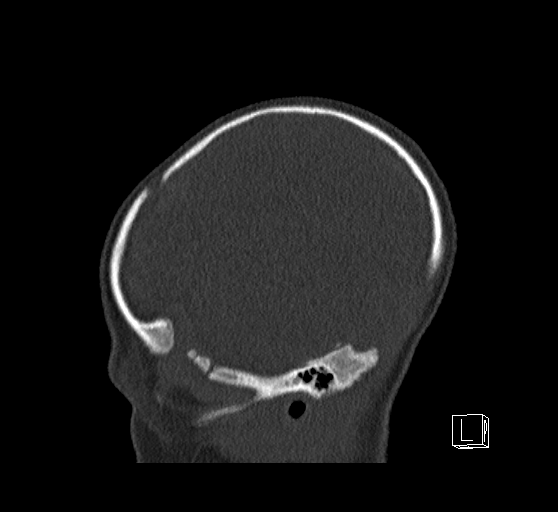 Bilateral subdural hemorrhage and parietal skull fracture (Radiopaedia 26058-26192 Sagittal bone window 15).png