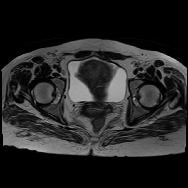 Bilateral tubo-ovarian abscesses (Radiopaedia 58635-65829 Axial T2 33).jpg
