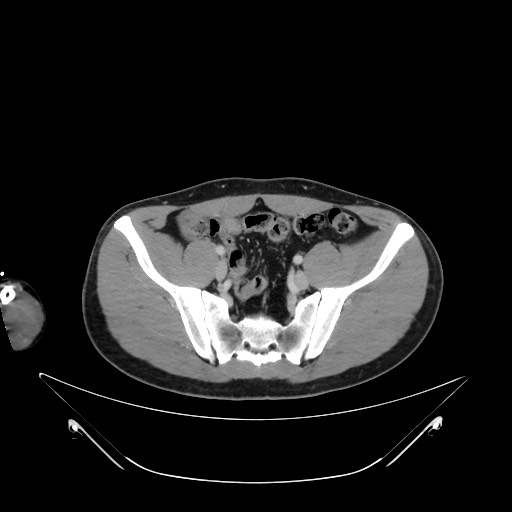 Bile leak from liver traumatic laceration (Radiopaedia 63463-72078 A 64).jpg