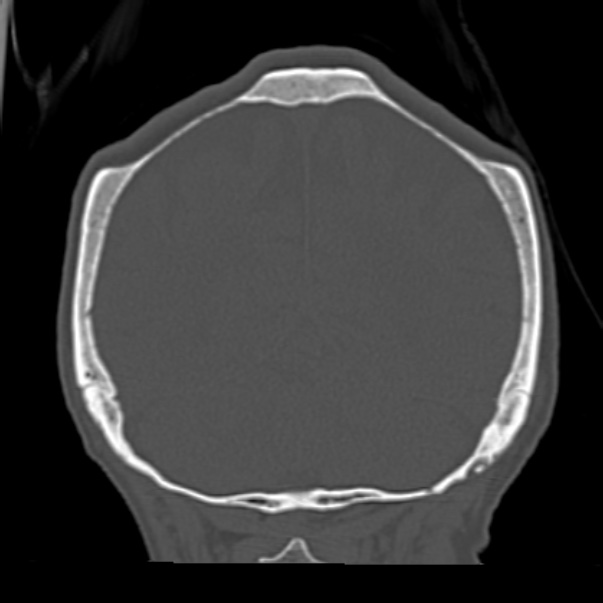Biparietal osteodystrophy (Radiopaedia 46109-50463 Coronal bone window 82).jpg