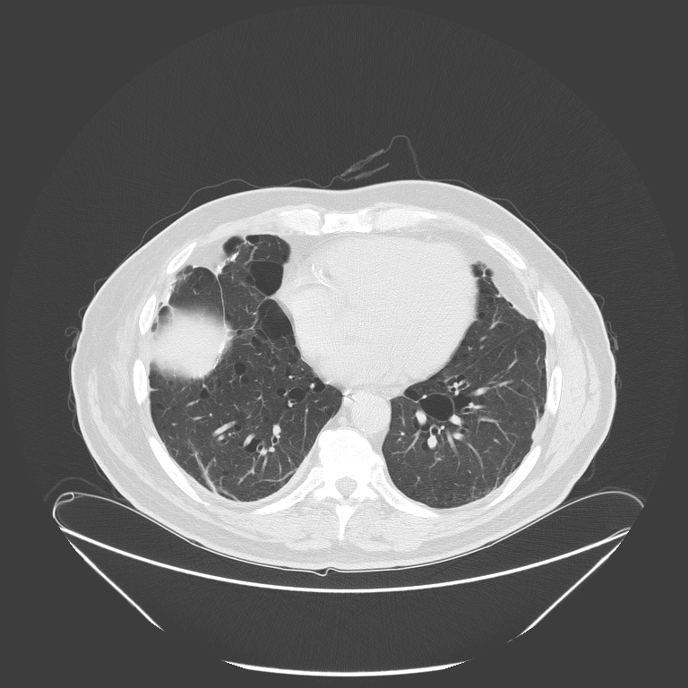 Birt-Hogg-Dubé syndrome (Radiopaedia 52578-58491 Axial lung window 41).jpg