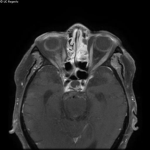 File:Bisphosphonate-related osteonecrosis of the maxilla (Radiopaedia 51367-57101 Axial T1 C+ fat sat 35).jpg