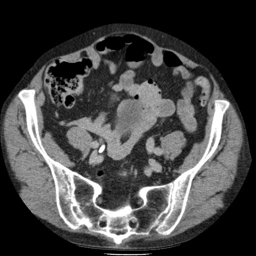 Bladder tumor detected on trauma CT (Radiopaedia 51809-57609 C 102).jpg