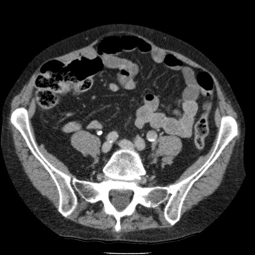 Bladder tumor detected on trauma CT (Radiopaedia 51809-57609 C 93).jpg