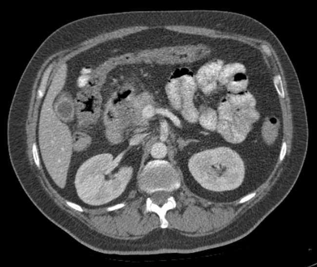 Bleeding duodenal ulcer and adenomyomatosis of gallbladder (Radiopaedia 61834-69861 A 41).jpg