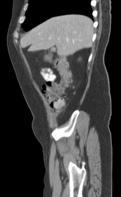 Bleeding duodenal ulcer and adenomyomatosis of gallbladder (Radiopaedia 61834-69861 C 17).jpg