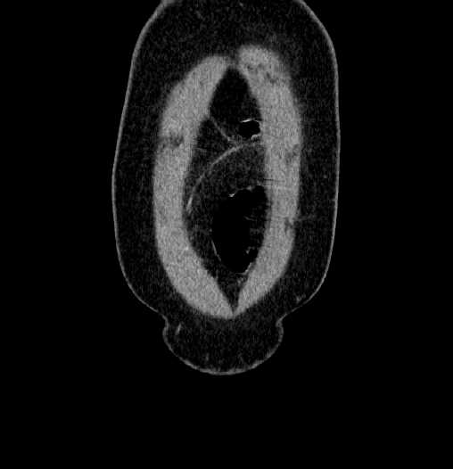 Blind-ending branch of a bifid ureter (Radiopaedia 61159-69048 F 3).jpg