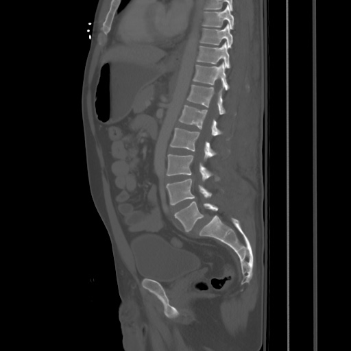 Blunt abdominal trauma with solid organ and musculoskelatal injury with active extravasation (Radiopaedia 68364-77895 Sagittal bone window 56).jpg