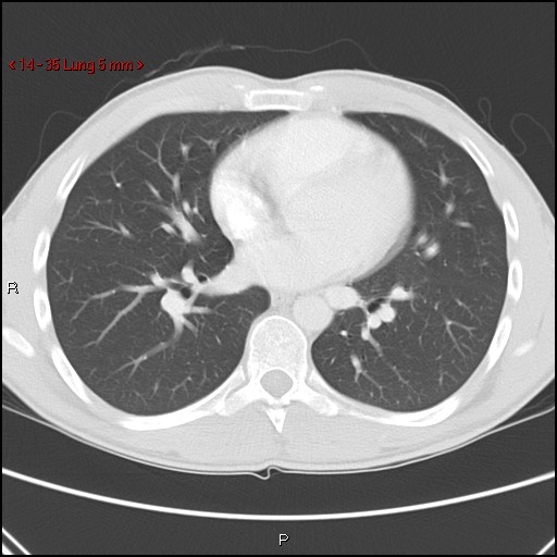 Blunt chest trauma - pulmonary interstitial emphysema and pneumomediastinum (Radiopaedia 20666-20552 Axial lung window 35).jpg