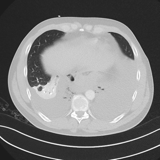 Boerhaave syndrome (Radiopaedia 39382-41660 Axial lung window 43).png