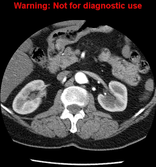 File:Bosniak renal cyst - type II (Radiopaedia 23404-23468 B 20).jpg