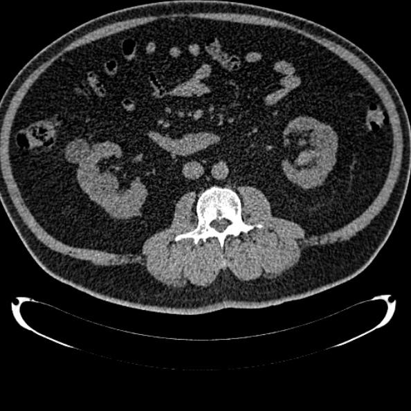 File:Bosniak renal cyst - type IV (Radiopaedia 24244-24518 Axial non-contrast 151).jpg