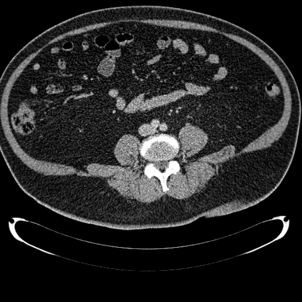 Bosniak renal cyst - type IV (Radiopaedia 24244-24518 C 241).jpg