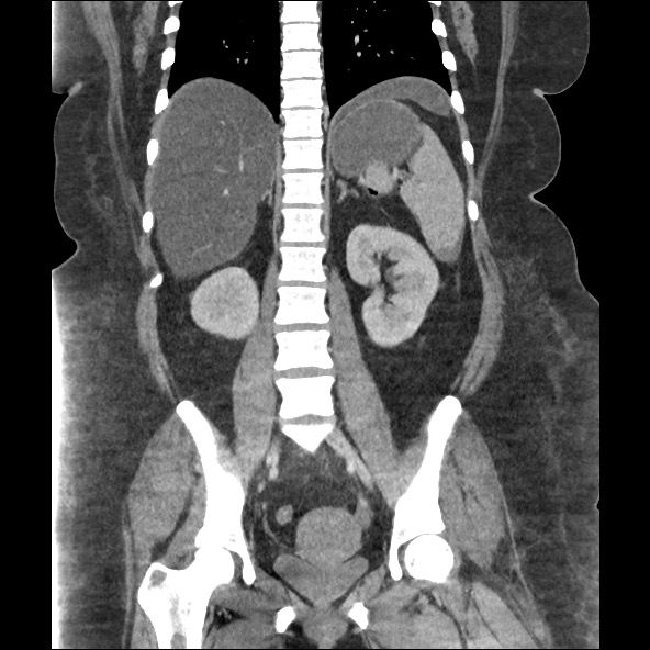 Bowel and splenic infarcts in acute lymphocytic leukemia (Radiopaedia 61055-68915 B 40).jpg