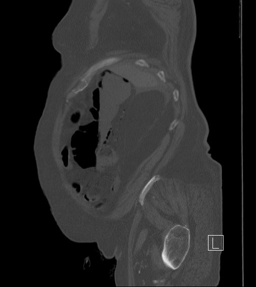 Bowel ischemia secondary to SMA occlusion with extensive portomesenteric venous gas (Radiopaedia 54656-60871 Sagittal bone window 100).jpg
