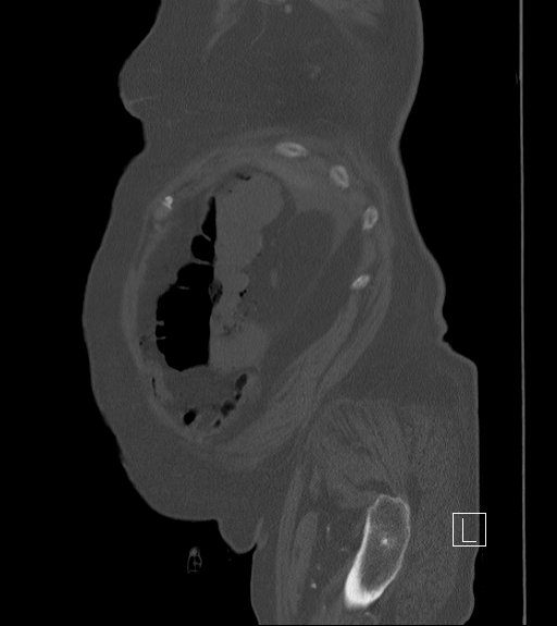 File:Bowel ischemia secondary to SMA occlusion with extensive portomesenteric venous gas (Radiopaedia 54656-60871 Sagittal bone window 103).jpg