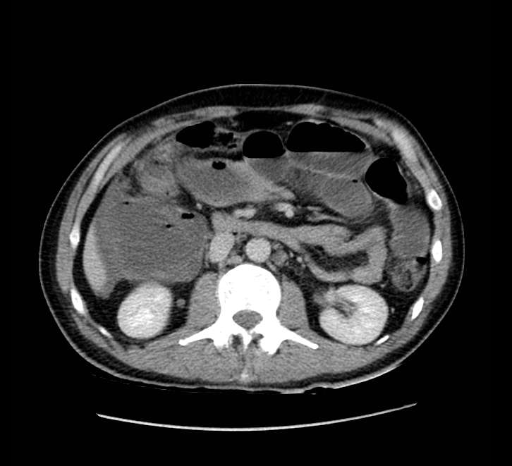 Bowel obstruction from colon carcinoma (Radiopaedia 22995-23028 A 35).jpg