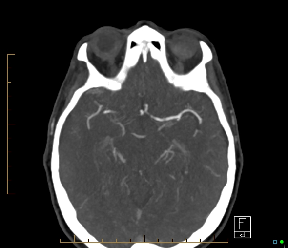 Brachiocephalic trunk stenosis (Radiopaedia 87242-103519 A 40).jpg