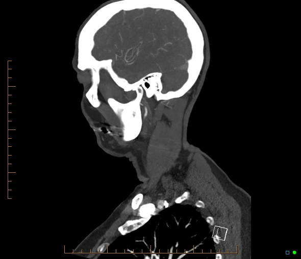 Brachiocephalic trunk stenosis (Radiopaedia 87242-103519 C 54).jpg