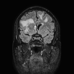 Brain metastases from lung cancer (Radiopaedia 83839-99028 Coronal FLAIR 29).jpg